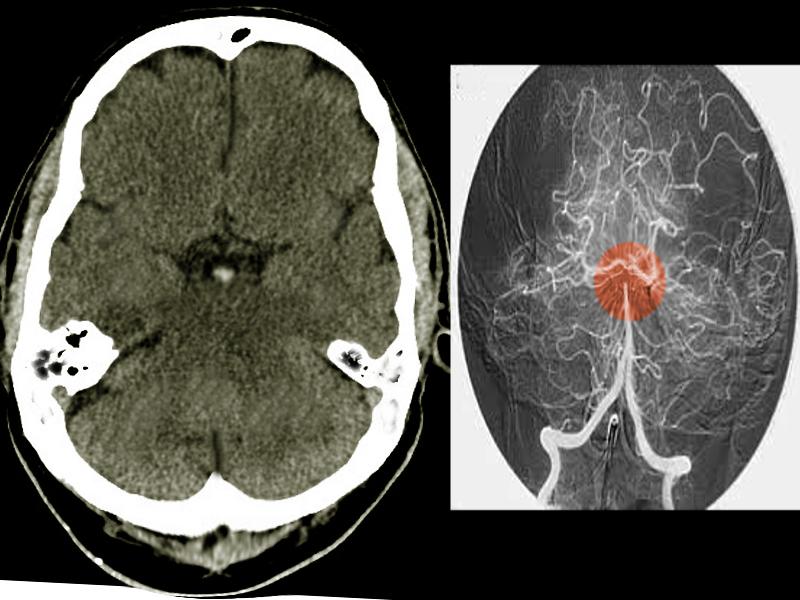 <p>Basilar Artery Infarct. Image revealing filling defects or the absence of flow within the basilar artery.</p>