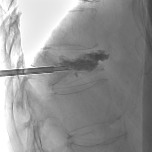 <p>Cement Injection During Percutaneous Kyphoplasty