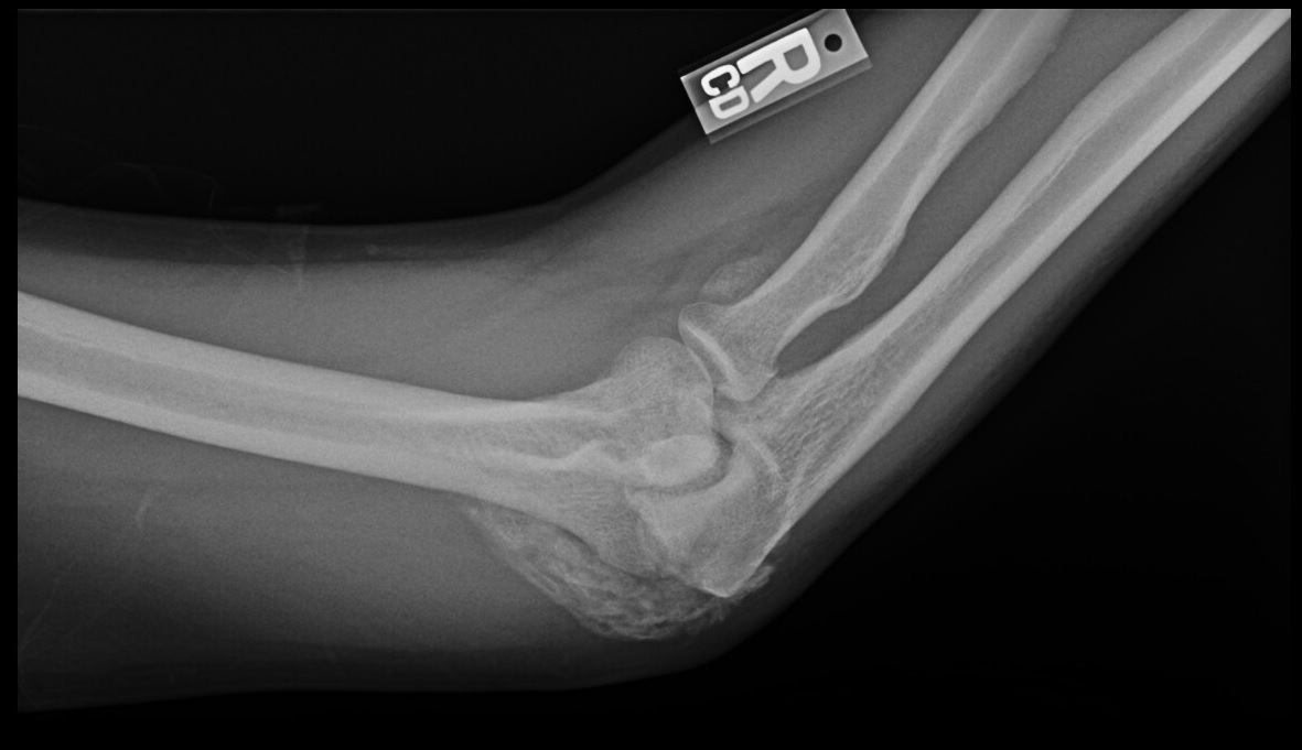 <p>Heterotopic Ossification of the Elbow, Radiograph