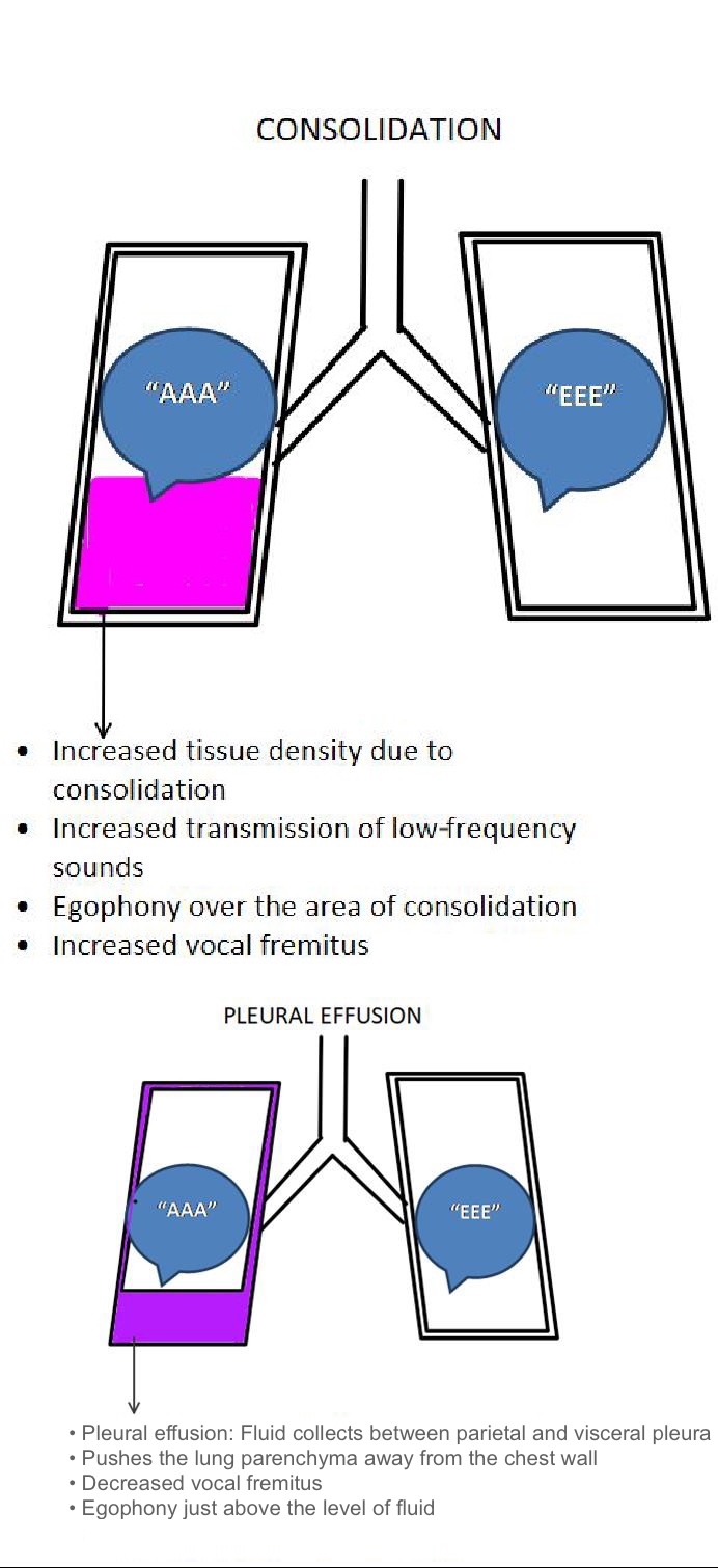 <p>Consolidation and Pleural Effusion