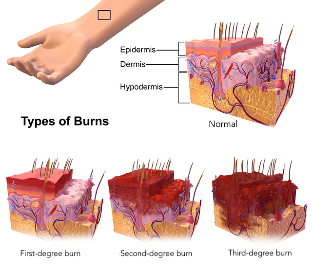 <p>Degrees of Burns.</p>