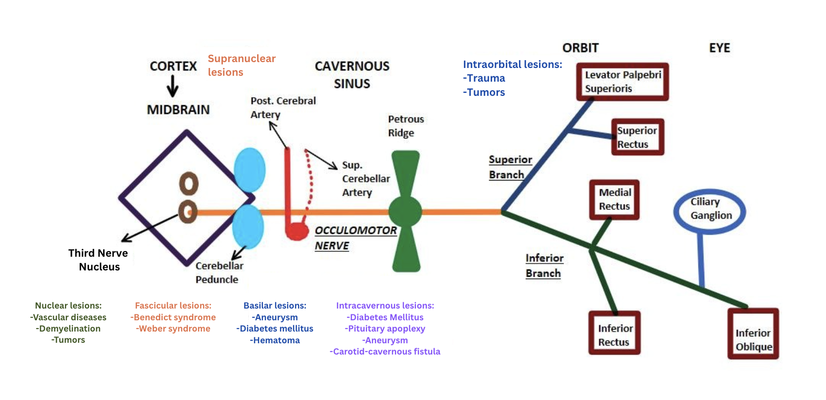 <p>Anatomical Sites of Oculomotor Nerve Lesions