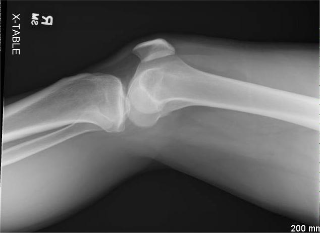 <p>Lateral Knee Showing Lipohemarthrosis, Radiograph