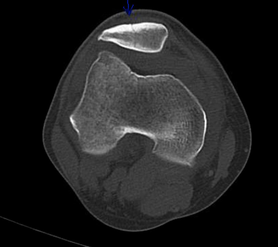<p>Knee Showing Nondisplaced Patellar Fracture With Lipohemarthrosis, Computed Tomography