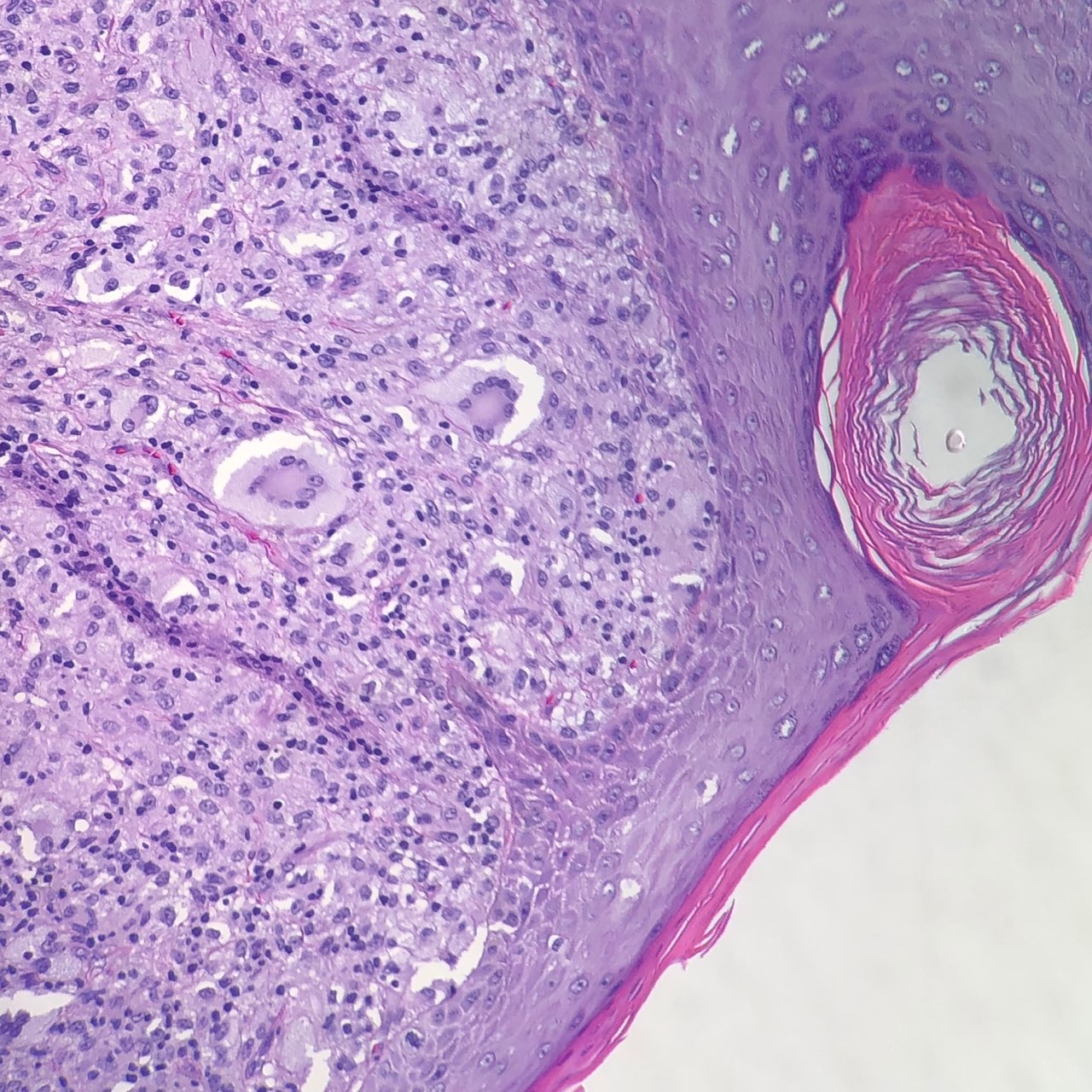 <p>Juvenile Xanthogranuloma.</p>