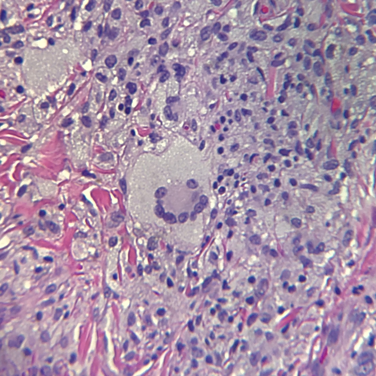 <p>Classic Multinucleated Giant (Touton) Cell of Juvenile Xanthogranuloma.</p>
