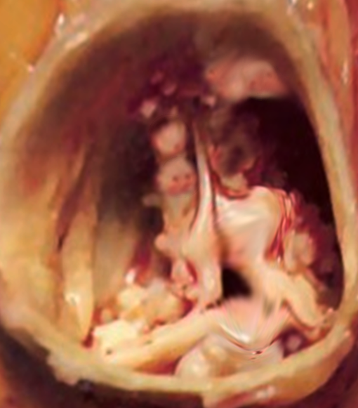 <p>Aortic Valve Stenosis.</p>