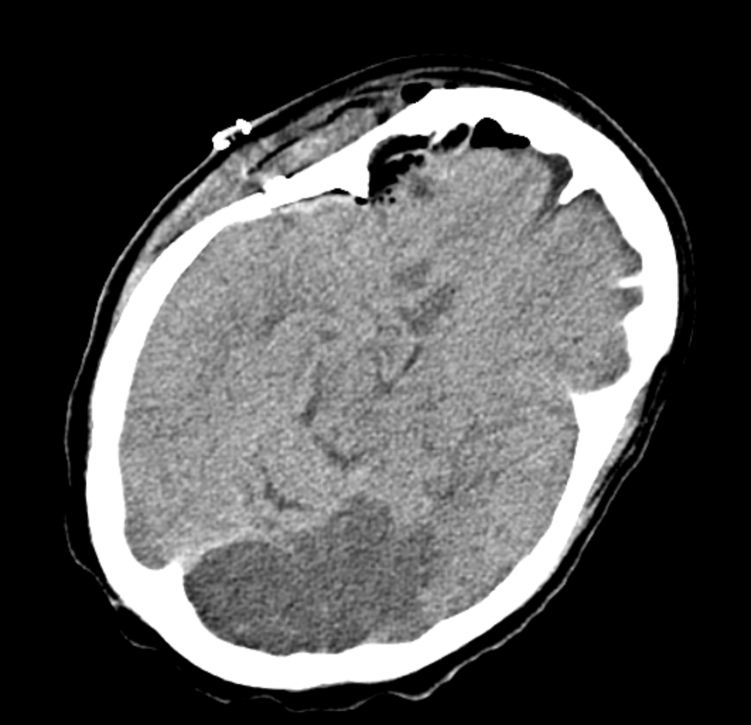 <p>Ischemic Stroke Without Hemorrhage