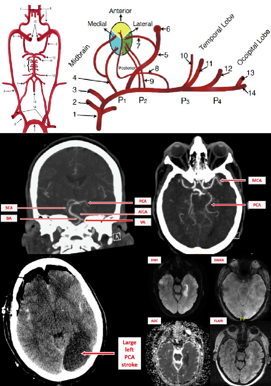 <p>Stroke, Posterior Cerebral Artery.</p>