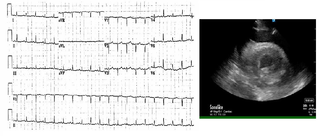 <p>Electrical Alternans in Pericardial Effusion