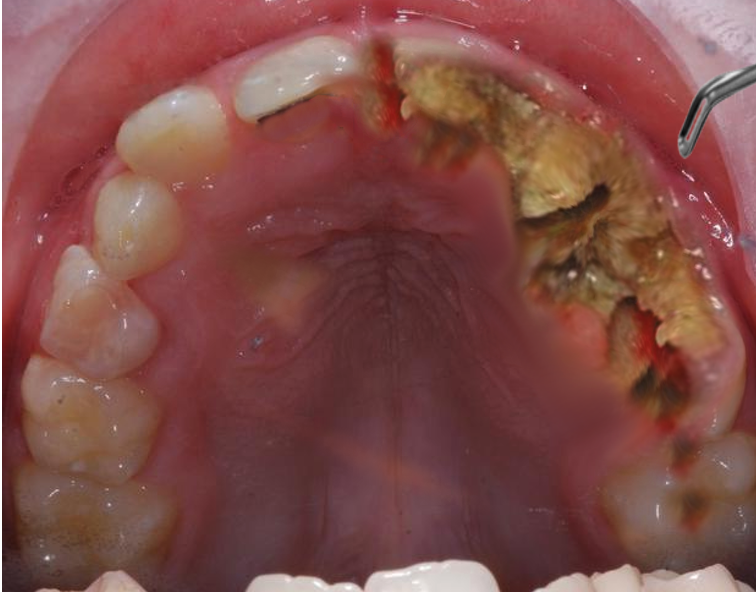 <p>Jaw Osteonecrosis.</p>