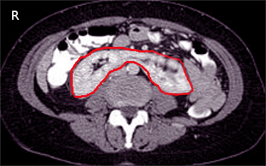 <p>Horseshoe Kidney on Computed Tomography