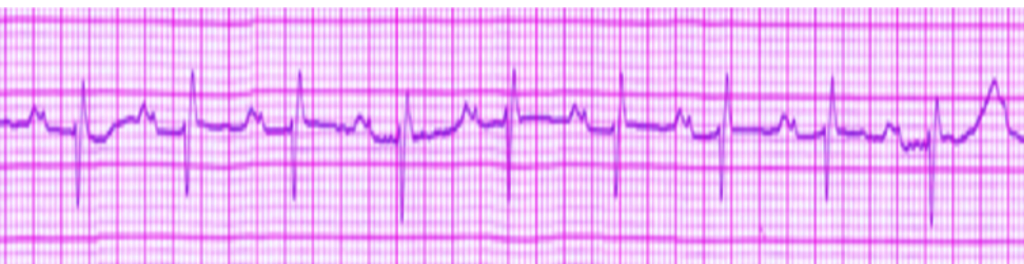 <p>ECG&nbsp;Left Atrial Enlargement. An ECG tracing indicative of left atrial enlargement.</p>