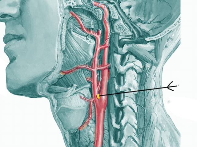 <p>Carotid Body.</p>