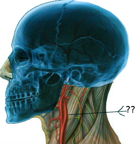 <p>Carotid Bifurcation.</p>