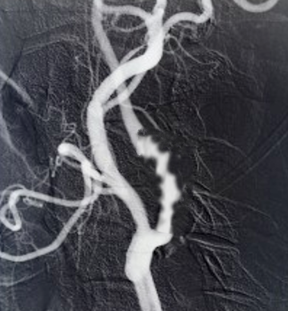 <p>Fibromuscular Dysplasia.</p>