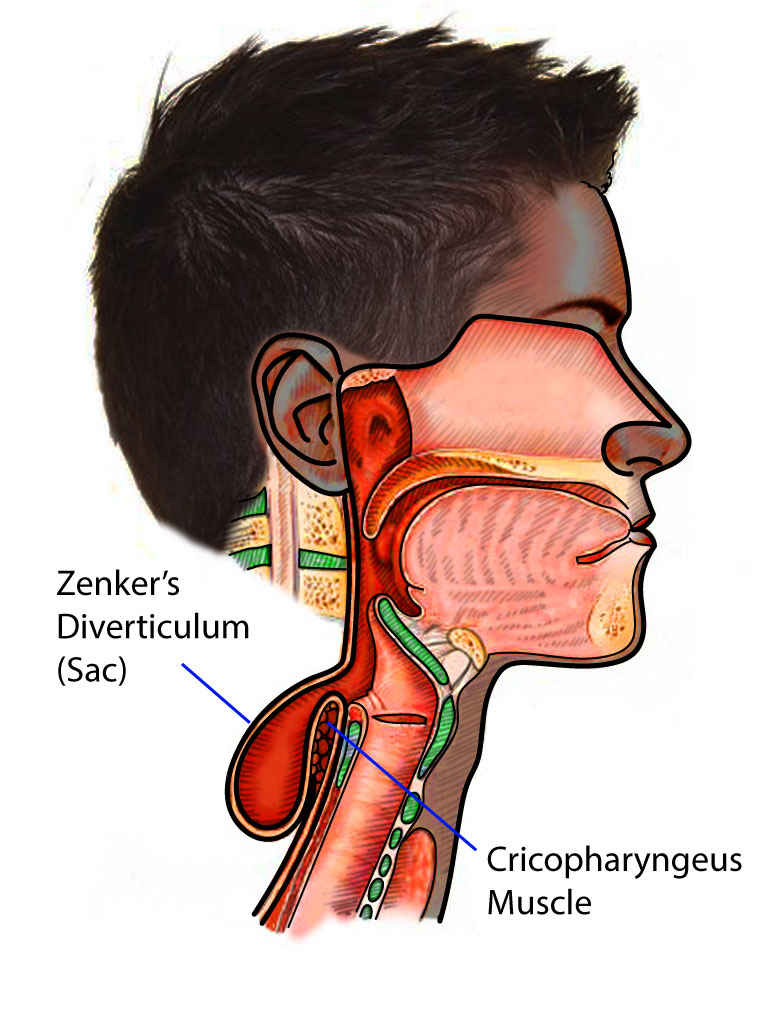 <p>Zenker Diverticulum.</p>