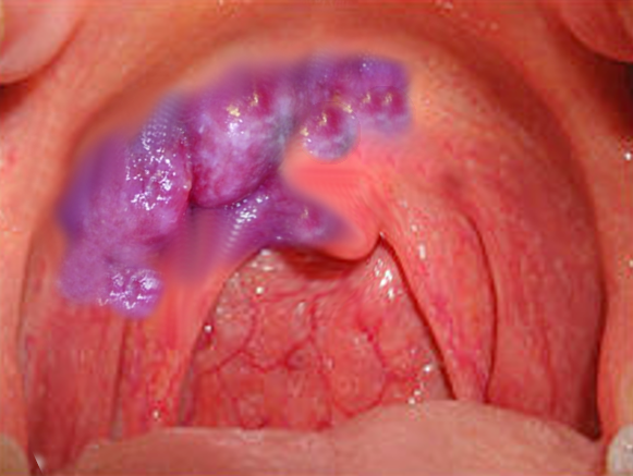 <p>Kaposi Sarcoma.</p>