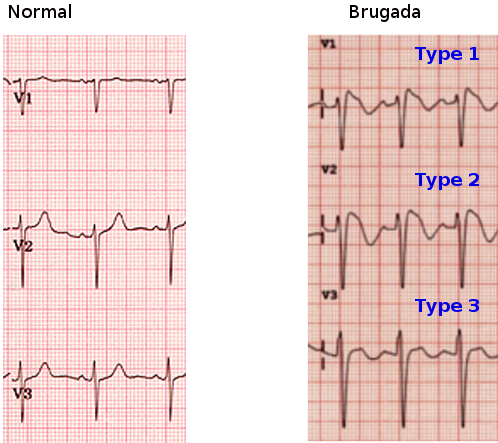 <p>Brugada Syndrome Electrocardiographic Patterns