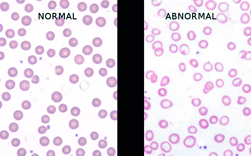 <p>Normal Versus Iron Deficiency Anemia