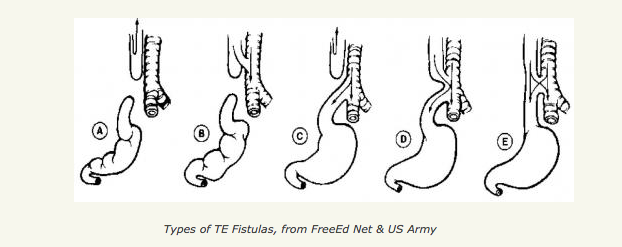 <p>Types of Tracheoesophageal Fistulas