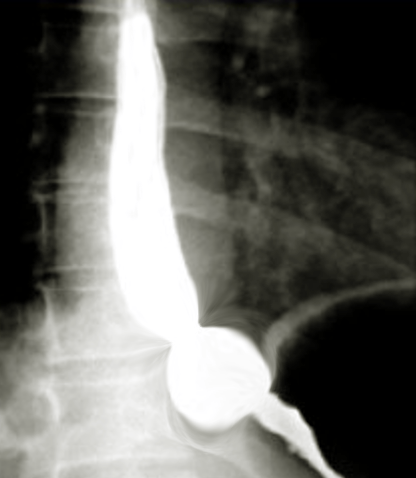 <p>Sliding Hiatal Hernia on Barium Study