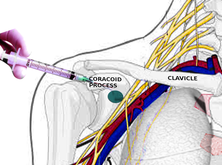 <p>Infraclavicular Block.</p>