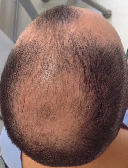 <p>Male-Pattern Androgenetic Alopecia. Hair loss is seen in the frontal, temporal, and central scalp areas.</p>