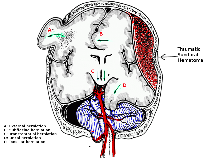 <p>Brain Herniation