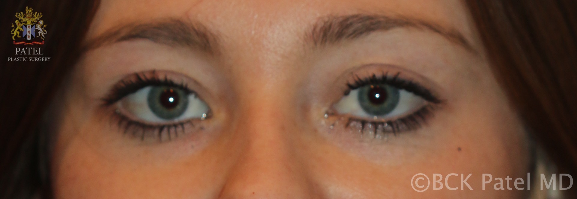 <p>Normal Eyelids in a Caucasian Female