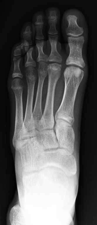 <p>Radiograph of Freiberg Disease in the Right Foot