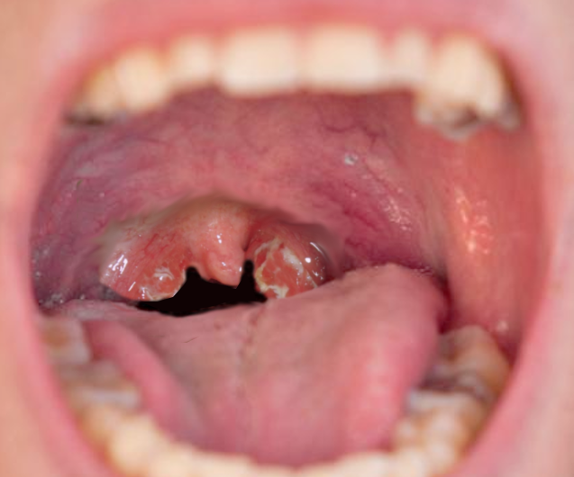 <p>Adenoiditis