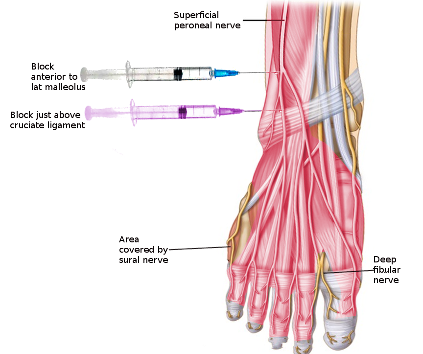<p>Superficial Peroneal Nerve Block</p>
<p>&nbsp;</p>
<p>&nbsp;</p>