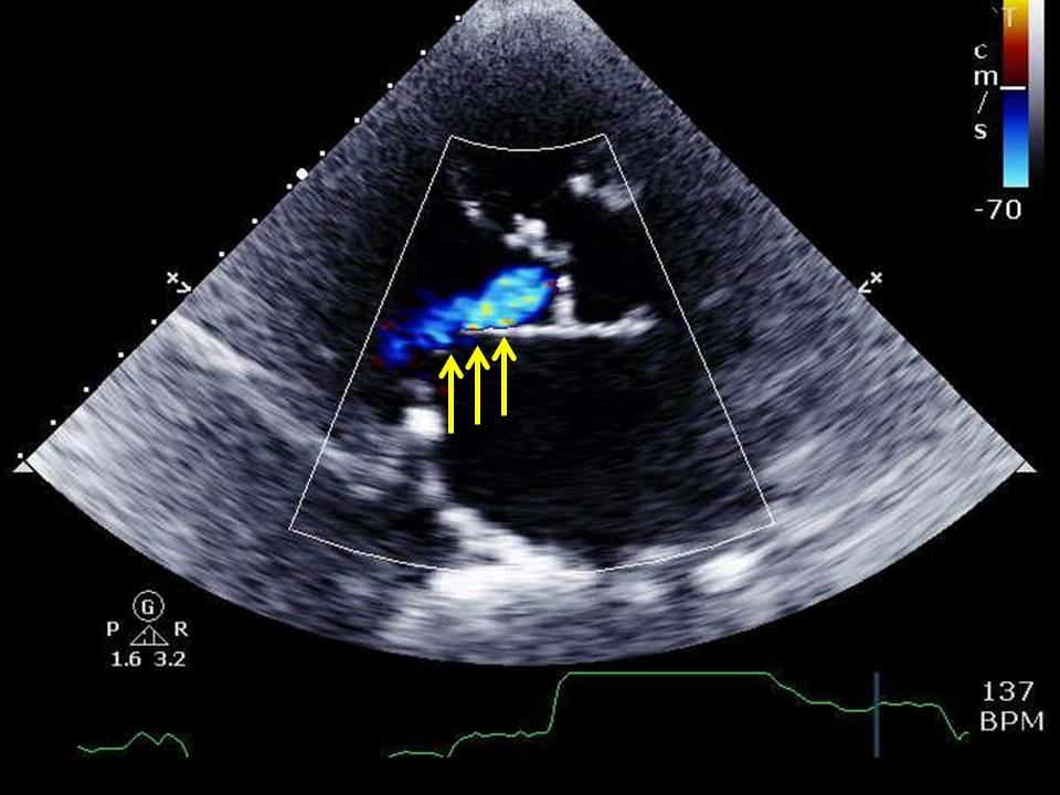<p>Parasternal Long-Axis Echocardiographic View of Aortic Insufficiency