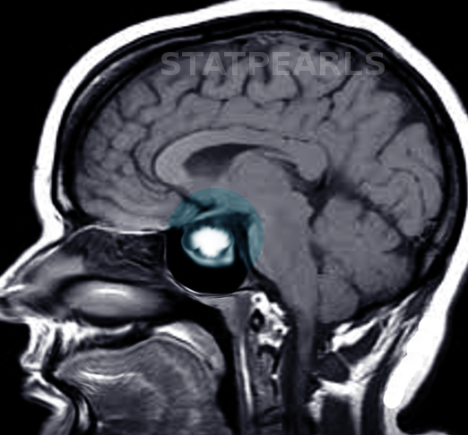 <p>&nbsp;Prolactinoma. Magnetic resonance imaging demonstrates an enhancing lesion in the sella turcica.&nbsp;</p>