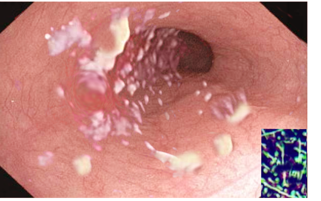 <p><em>Candida</em> Esophagitis