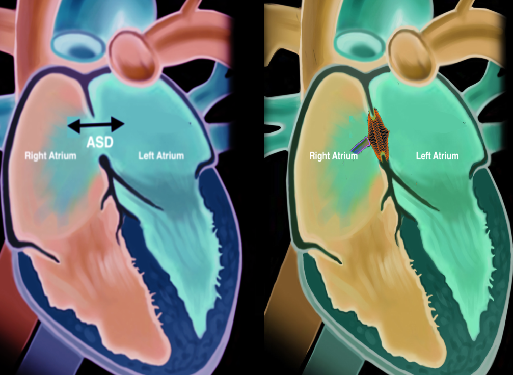 <p>Atrial Septal Defect Closure