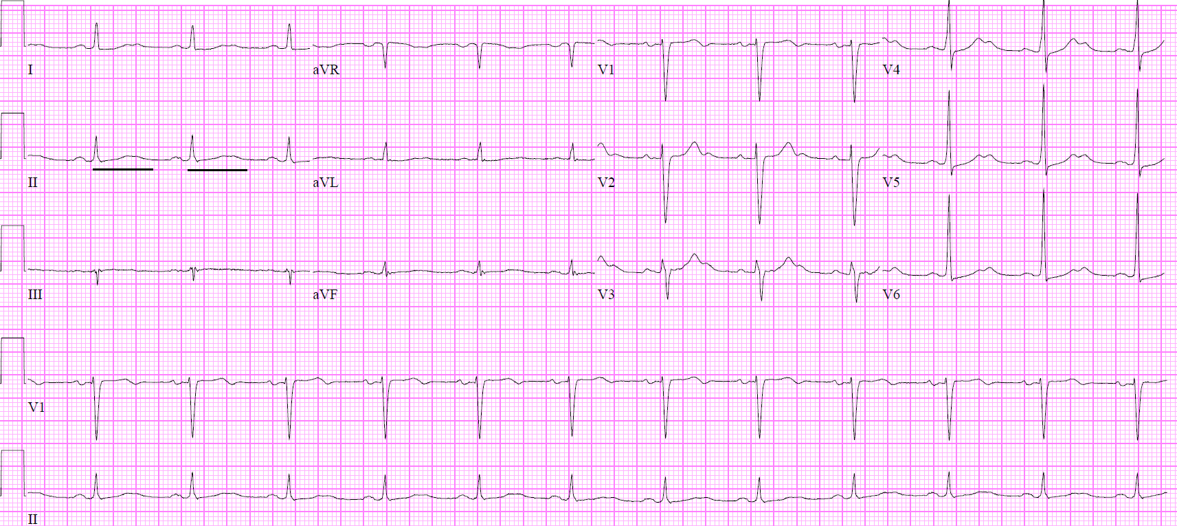 <p>ECG Prolonged QTc.</p>