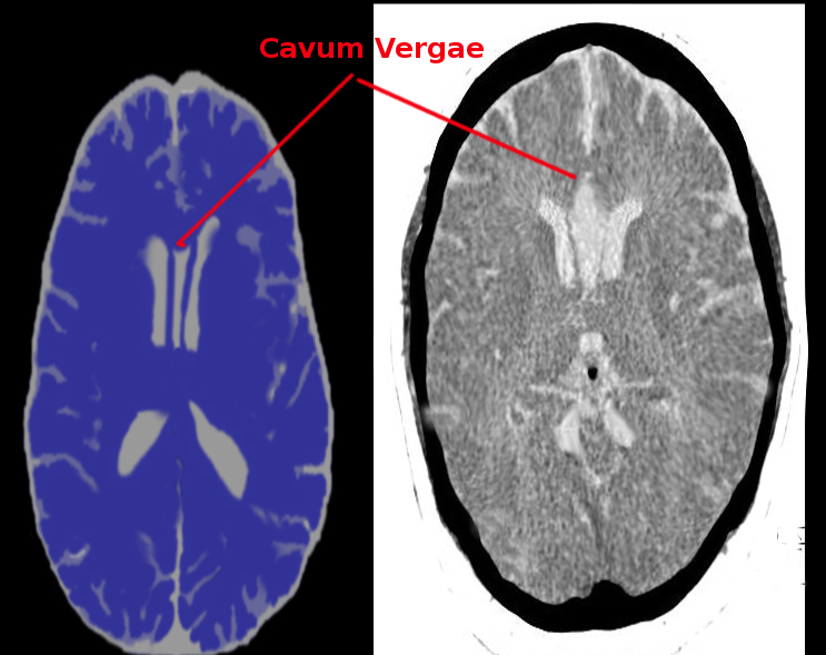 <p>Cavum Septi Pellucidi and Cavum Vergae