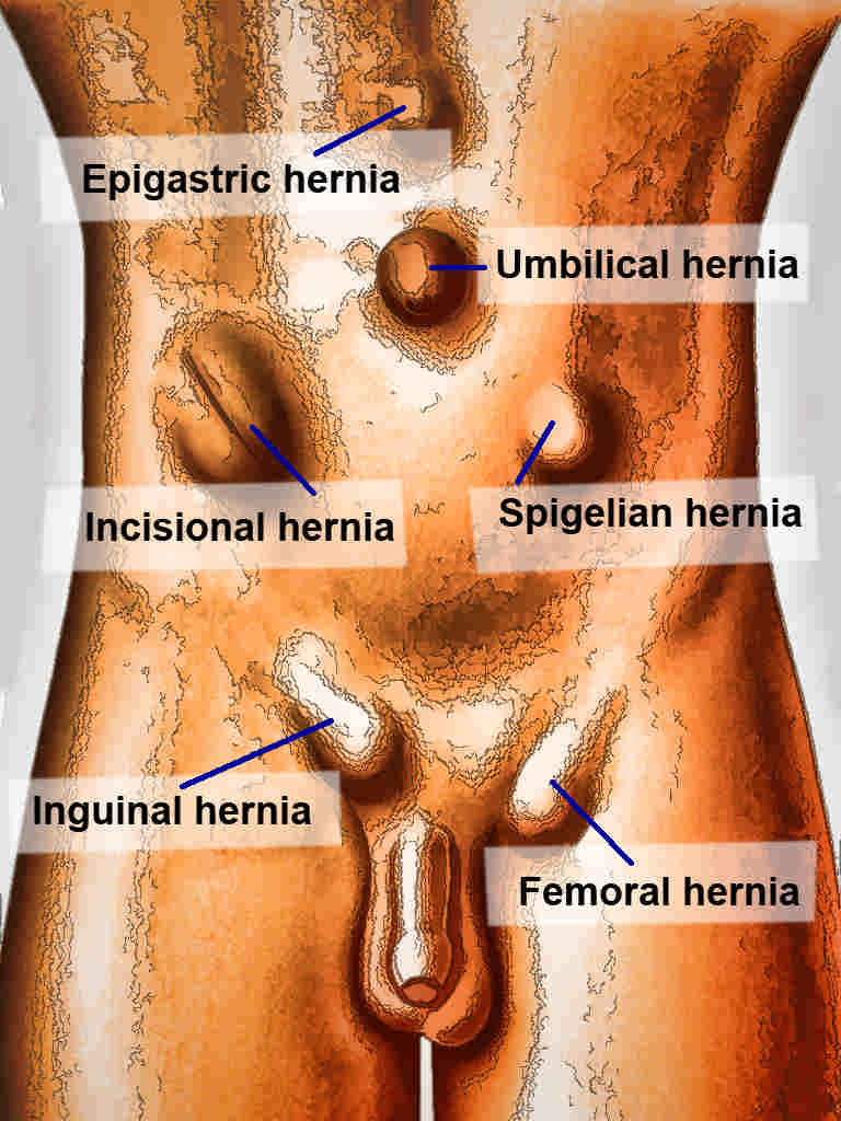 <p>Abdominal Hernias.</p>