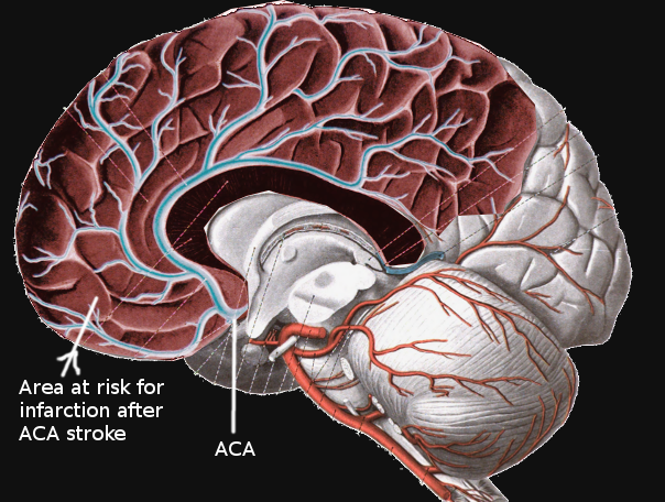 <p>Anterior Cerebral Artery Stroke