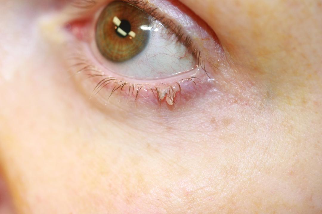 <p>Eyelid Papilloma. Image of a patient with an eyelid papilloma.</p>