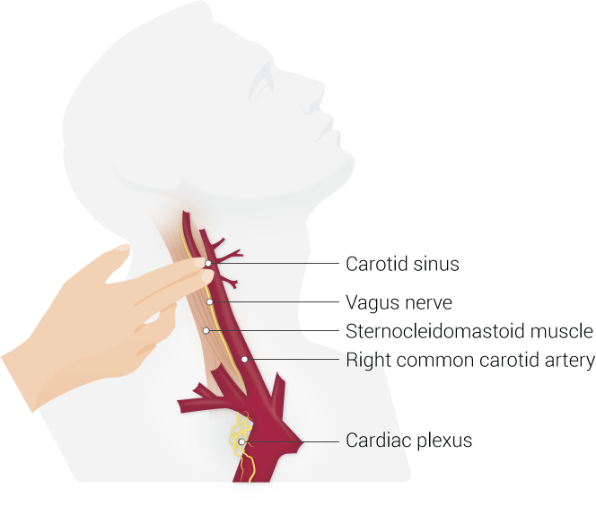<p>Carotid Sinus Massage Technique