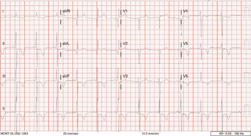 <p>Electrocardiography in a Case of Severe Aortic Stenosis