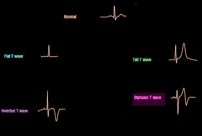 <p>T-Wave Morphology