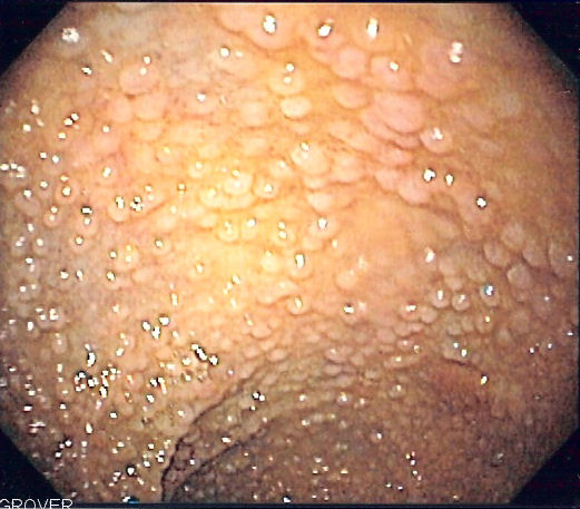 <p>Diffuse Colonic Polyposis on Sigmoidoscopy