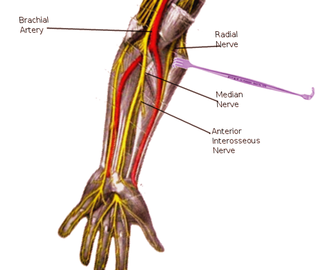 <p>Anterior Interosseous Nerve. The Image shows the anterior interosseous nerve and surrounding nerves.</p>