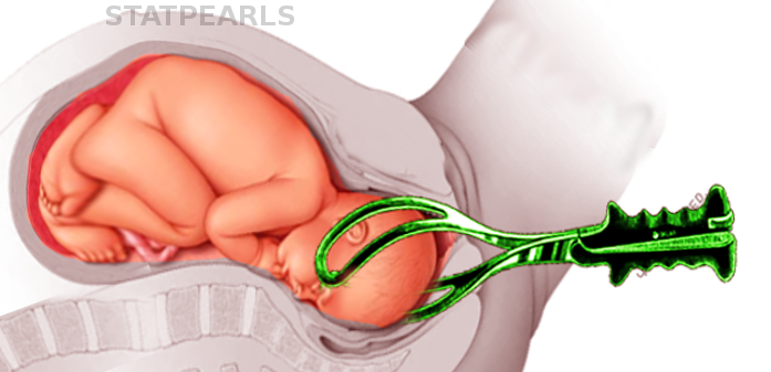 <p>Forceps Delivery. This image demonstrates the application of forceps during a vaginal delivery.</p>