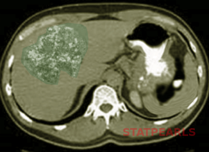 <p>Hepatic Angiosarcoma