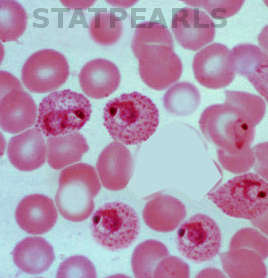 <p>Blood Smear Malaria.</p>